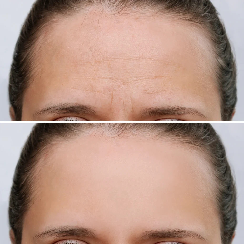 Botox treatment before and after results at ProloHealing in Denville, NJ