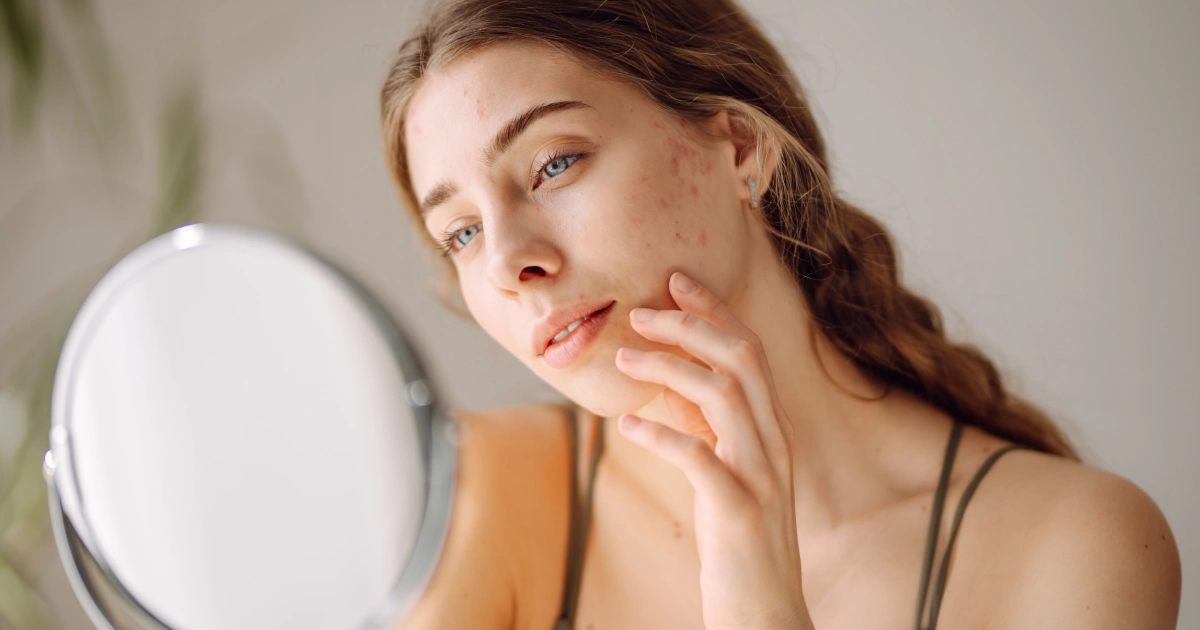 Microneedling for Acne Scars at Ascend Regenerative
