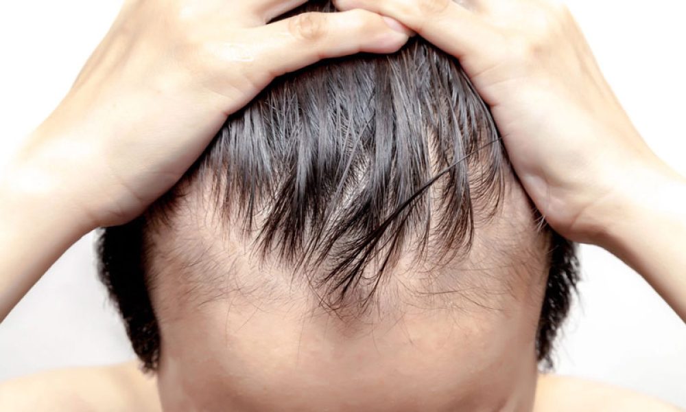 Hair Loss treatment for Males at ProloHealing Medspa in Denville, NJ