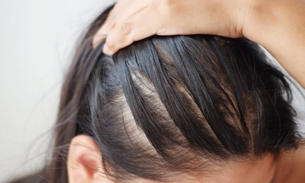 Hair Loss treatments for Females at ProloHealing Medspa in Denville, NJ