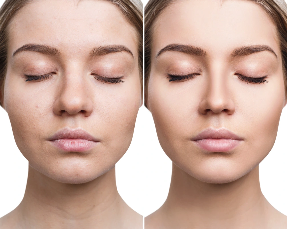 Microneedling Facial Rejuvenation before and after results at Ascend Regenerative in Denville, NJ